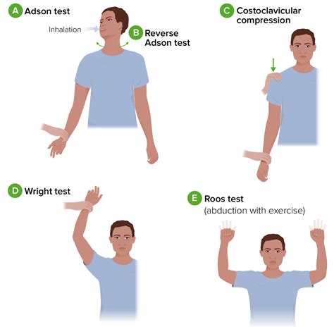 tests for thoracic outlet syndrome